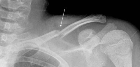 Röntgenfoto gebroken sleutelbeen kind